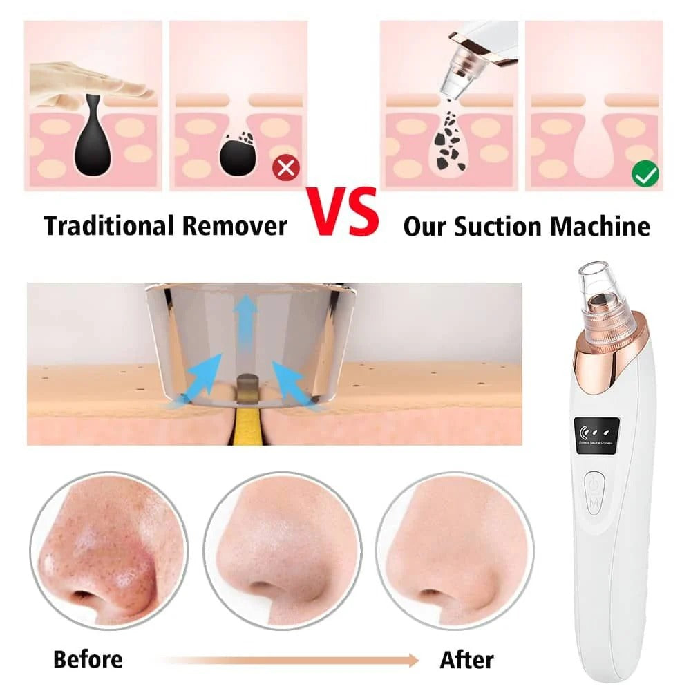 Blackhead Vacuum Remover – Electric Pore Cleanser